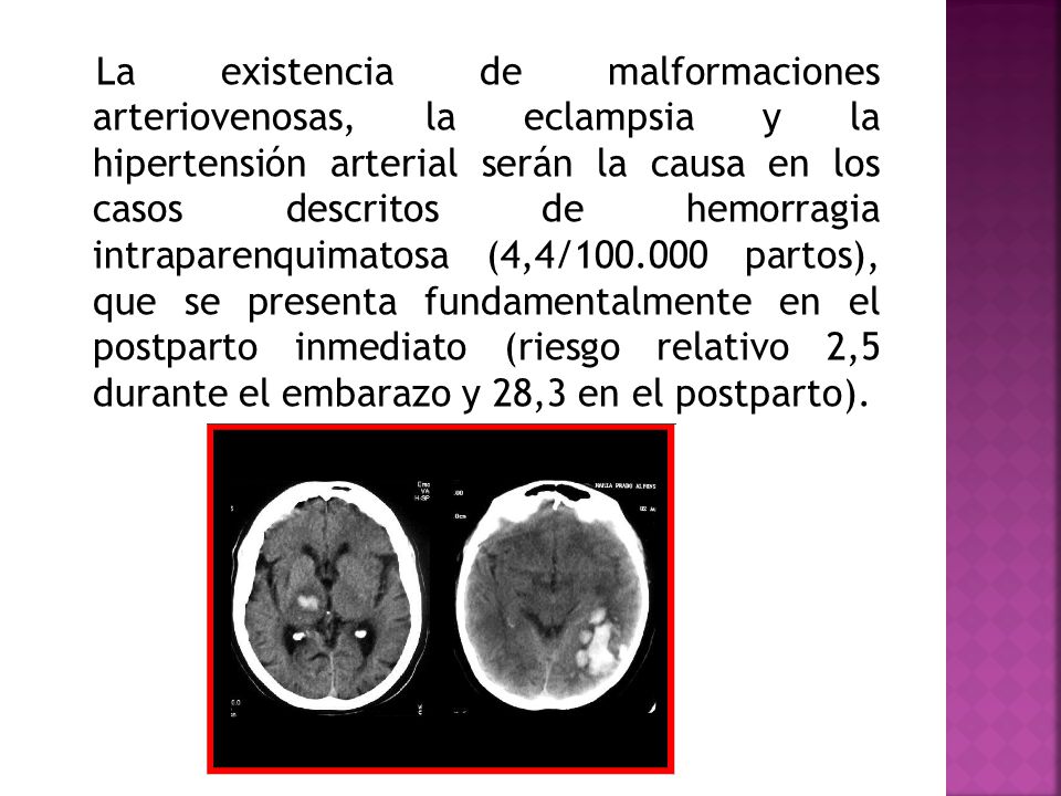 La existencia de malformaciones arteriovenosas, la eclampsia y la hipertensión arterial serán la causa en los casos descritos de hemorragia intraparenquimatosa (4,4/ partos), que se presenta fundamentalmente en el postparto inmediato (riesgo relativo 2,5 durante el embarazo y 28,3 en el postparto).