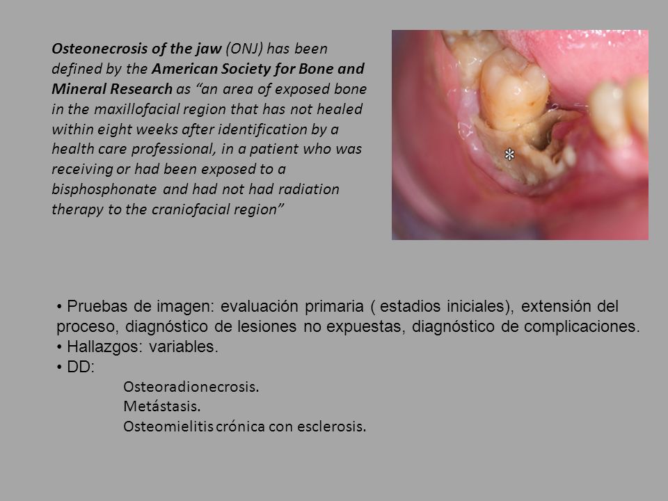 Osteonecrosis of the jaw (ONJ) has been defined by the American Society for Bone and Mineral Research as an area of exposed bone in the maxillofacial region that has not healed within eight weeks after identification by a health care professional, in a patient who was receiving or had been exposed to a bisphosphonate and had not had radiation therapy to the craniofacial region