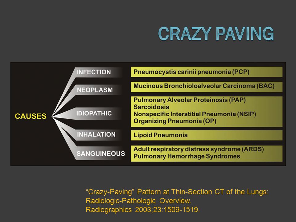 CRAZY PAVING Crazy-Paving Pattern at Thin-Section CT of the Lungs: Radiologic-Pathologic Overview.