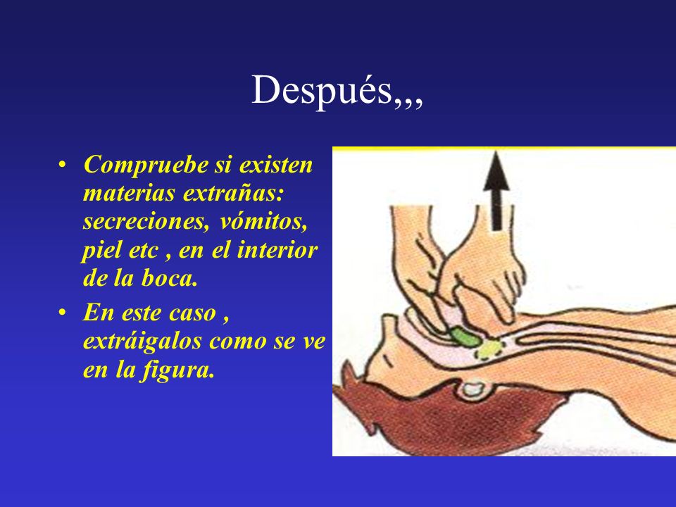 Después,,, Compruebe si existen materias extrañas: secreciones, vómitos, piel etc , en el interior de la boca.