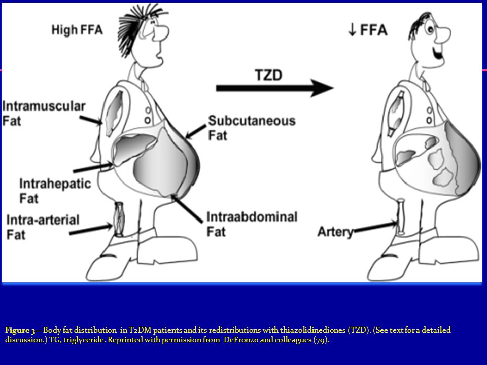 Figure 3—Body fat distribution in T2DM patients and its redistributions with thiazolidinediones (TZD).