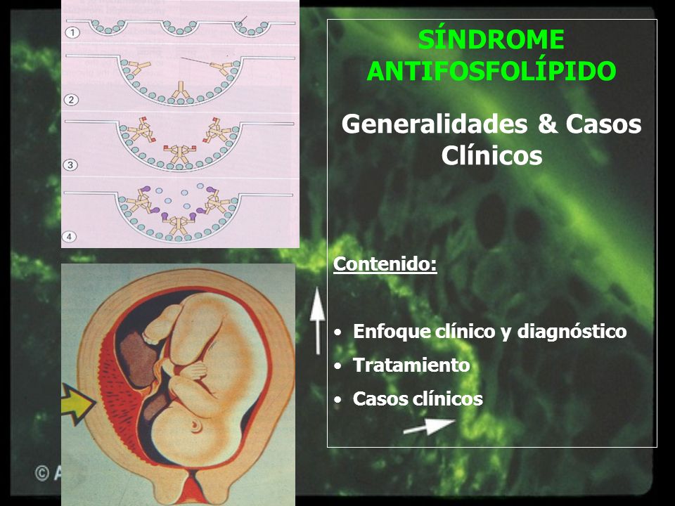 SÍNDROME ANTIFOSFOLÍPIDO Generalidades & Casos Clínicos