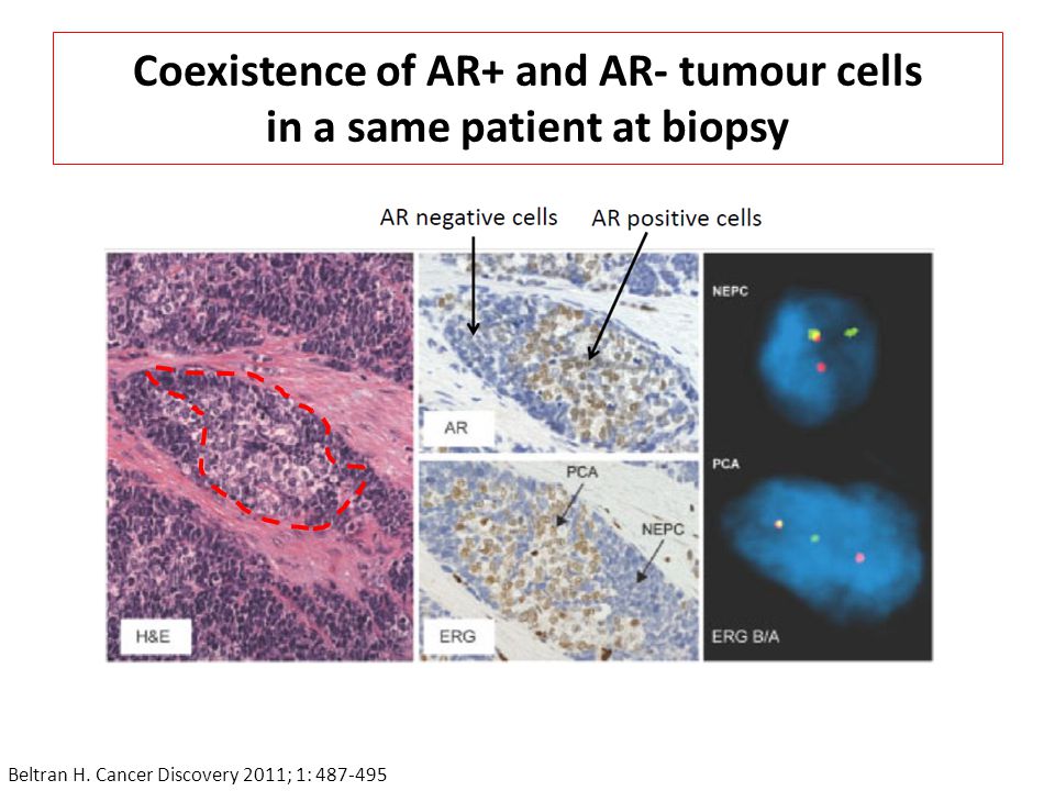 Coexistence of AR+ and AR- tumour cells in a same patient at biopsy