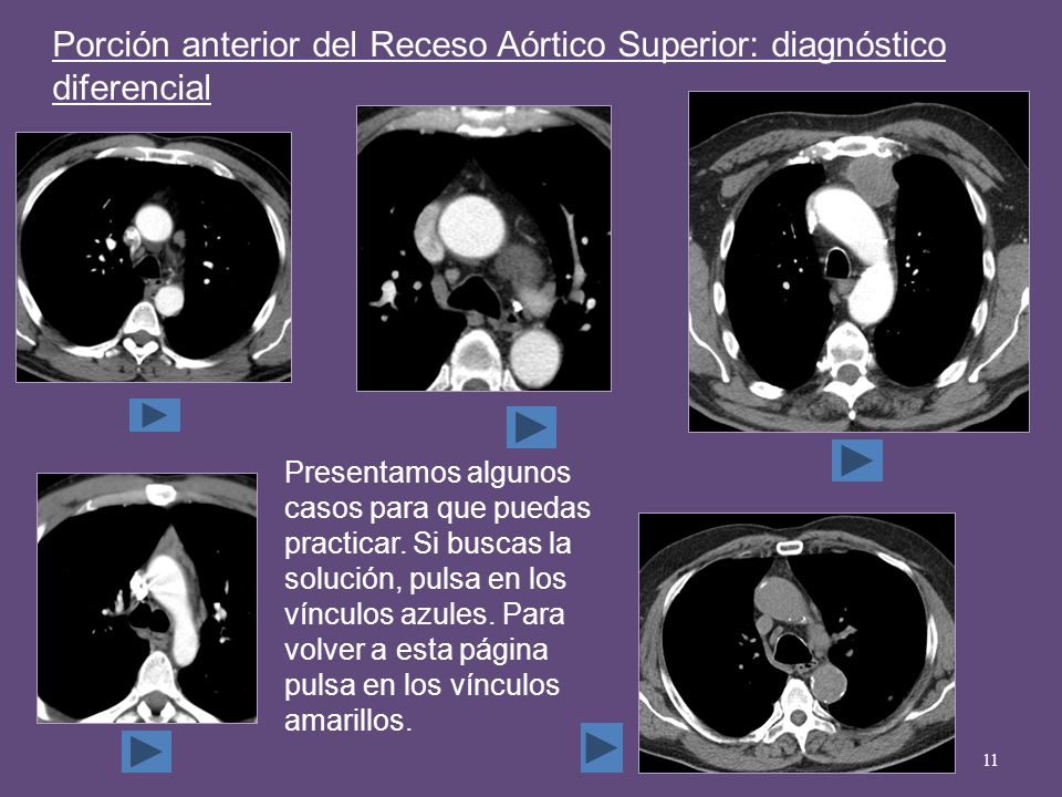 Porción anterior del Receso Aórtico Superior: diagnóstico diferencial