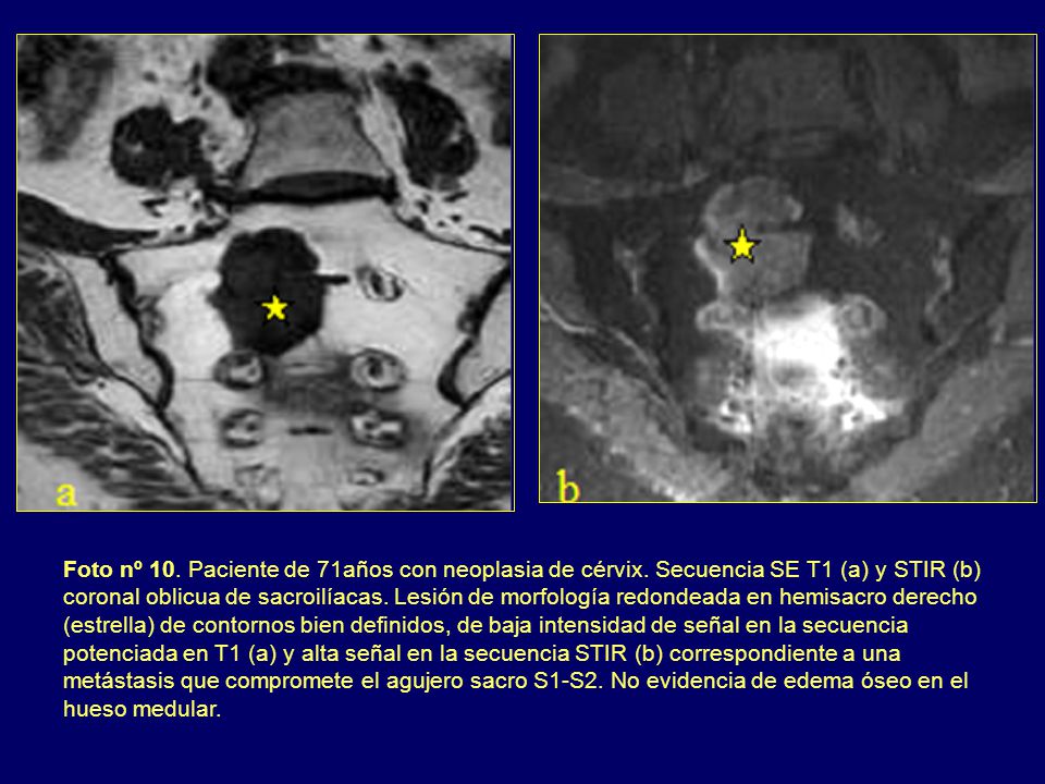 Foto nº 10. Paciente de 71años con neoplasia de cérvix