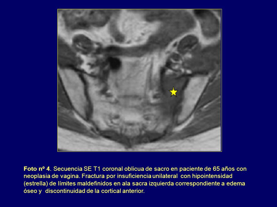 Foto nº 4. Secuencia SE T1 coronal oblicua de sacro en paciente de 65 años con neoplasia de vagina.