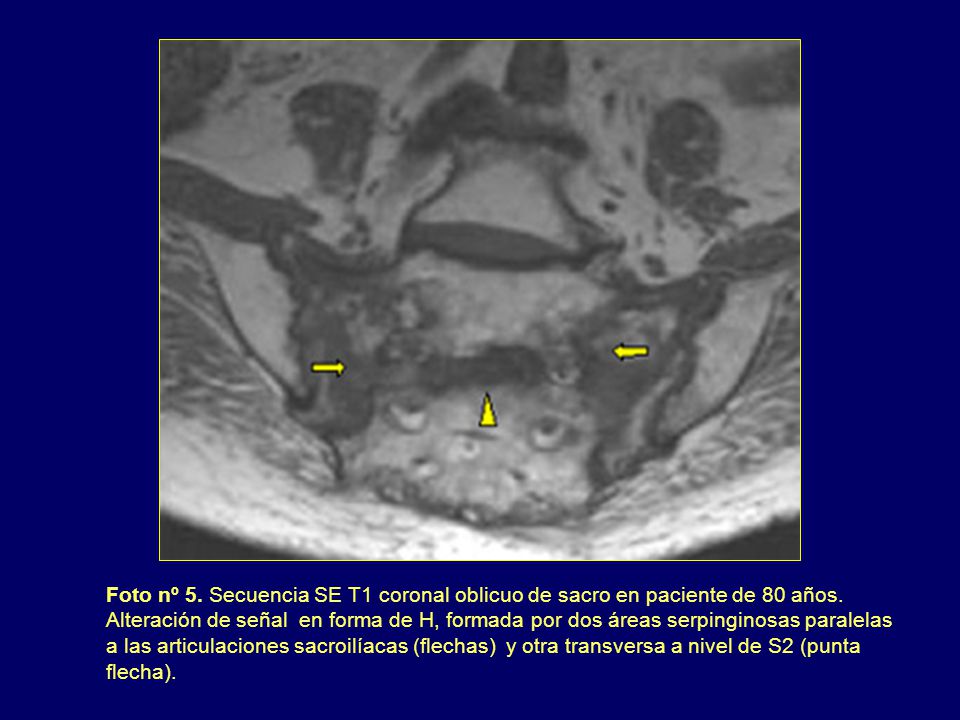 Foto nº 5. Secuencia SE T1 coronal oblicuo de sacro en paciente de 80 años.