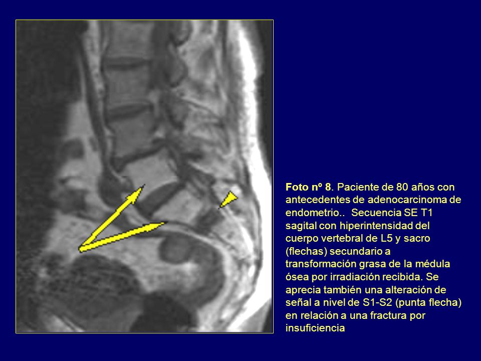 Foto nº 8. Paciente de 80 años con antecedentes de adenocarcinoma de endometrio..