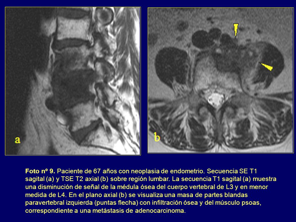 Foto nº 9. Paciente de 67 años con neoplasia de endometrio