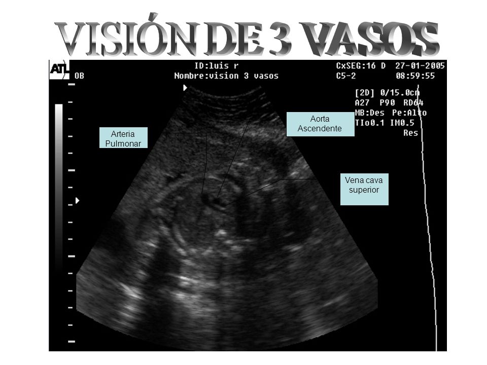 VISIÓN DE 3 VASOS Aorta Ascendente Arteria Pulmonar Vena cava superior