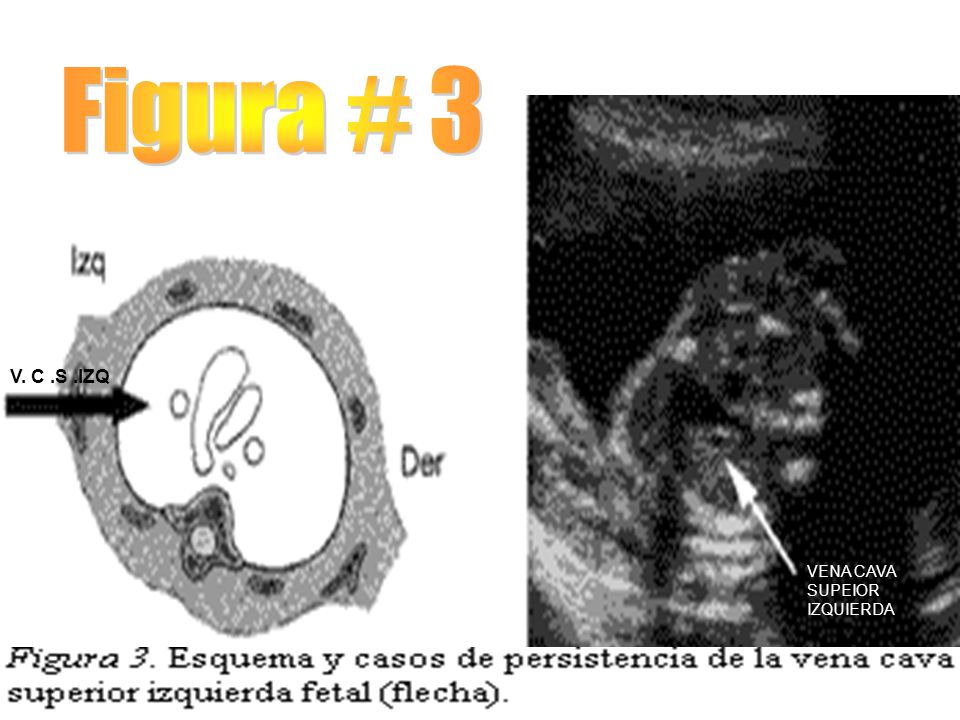Figura # 3 V. C .S .IZQ VENA CAVA SUPEIOR IZQUIERDA