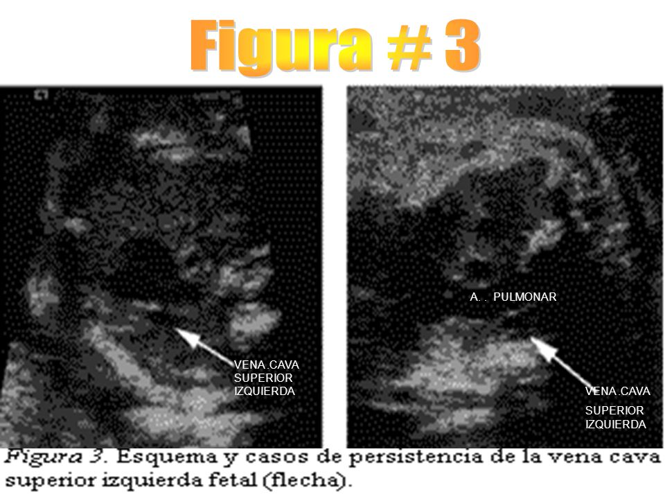 Figura # 3 A. . PULMONAR VENA .CAVA SUPERIOR IZQUIERDA VENA .CAVA