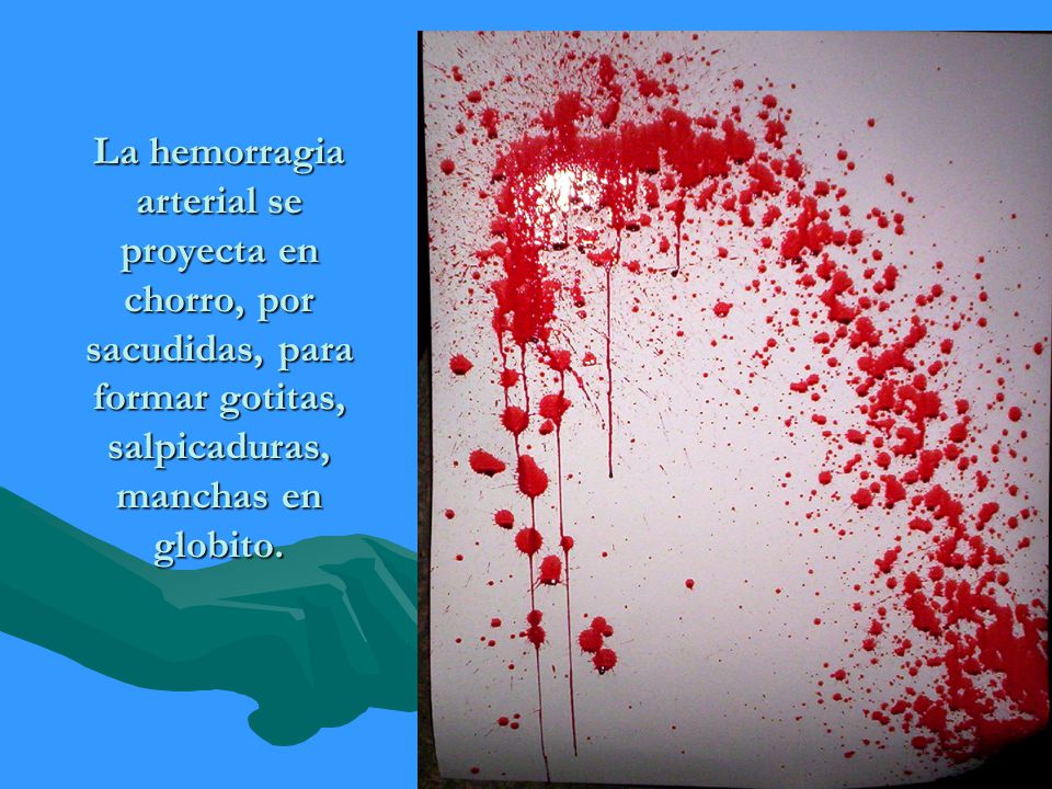 La hemorragia arterial se proyecta en chorro, por sacudidas, para formar gotitas, salpicaduras, manchas en globito.
