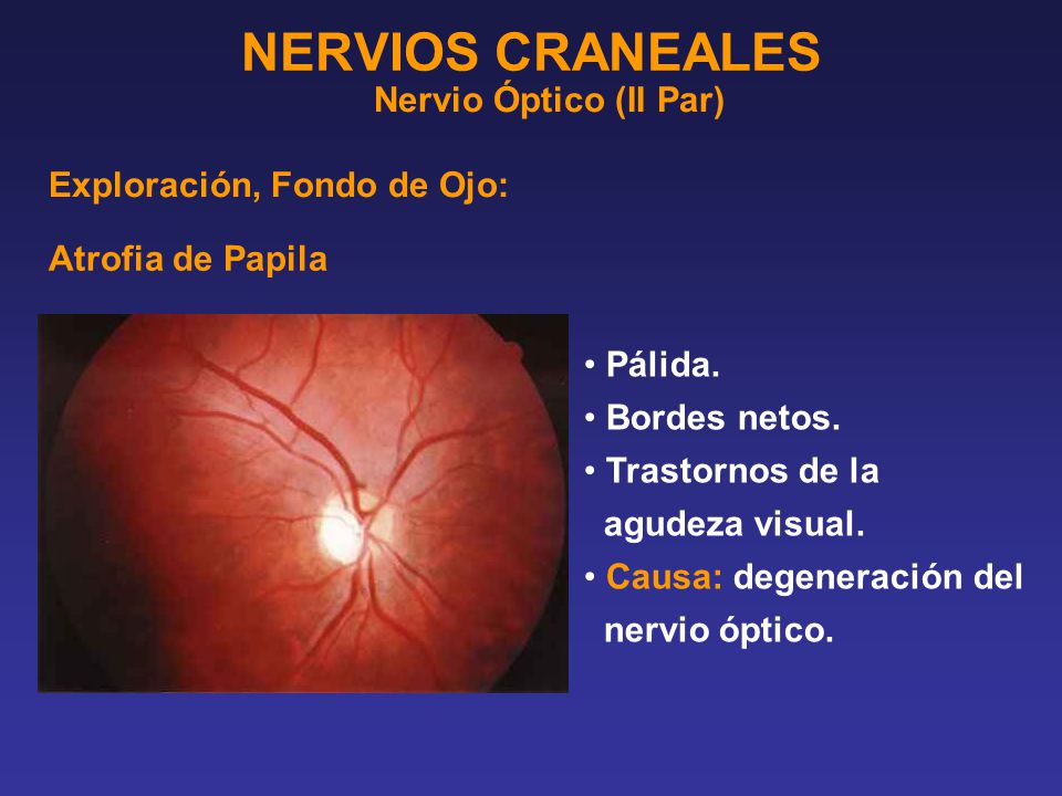NERVIOS CRANEALES Nervio Óptico (II Par) Exploración, Fondo de Ojo: