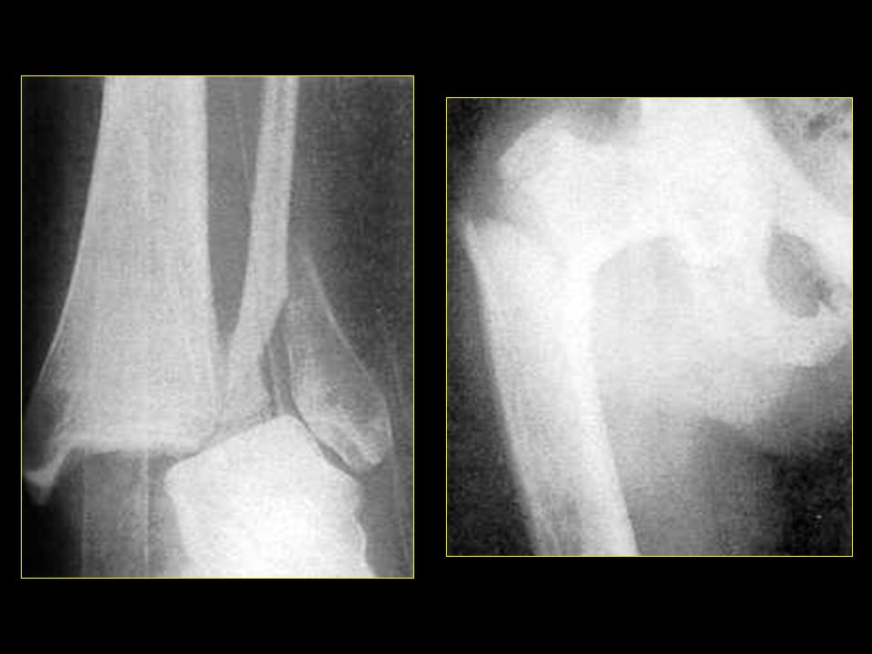 Fx desplazada 1/3 distal del peroné. Fractura trocánter mayor del fémur.