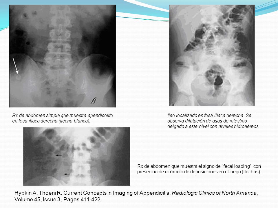 Rx de abdomen simple que muestra apendicolito en fosa ilíaca derecha (flecha blanca).