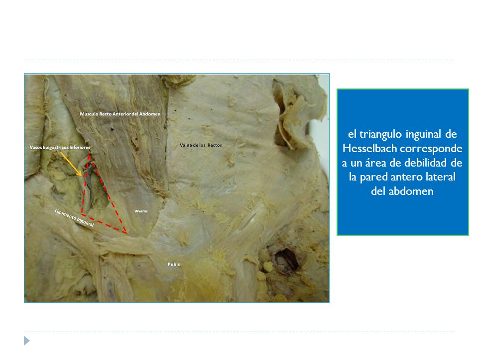 el triangulo inguinal de Hesselbach corresponde a un área de debilidad de la pared antero lateral del abdomen