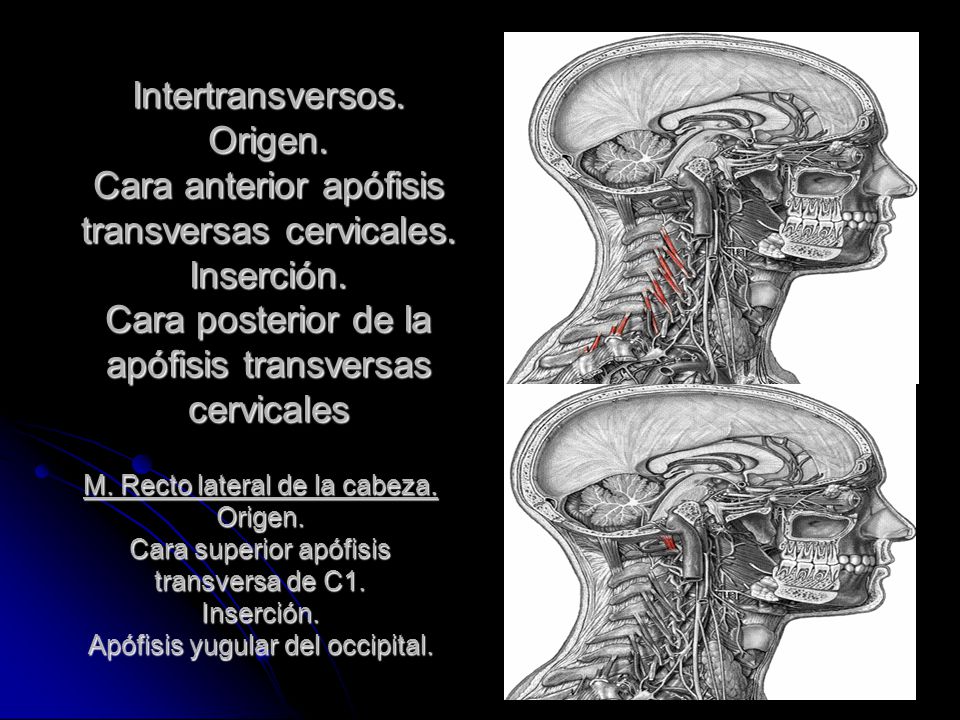 Intertransversos. Origen. Cara anterior apófisis transversas cervicales. Inserción. Cara posterior de la apófisis transversas cervicales