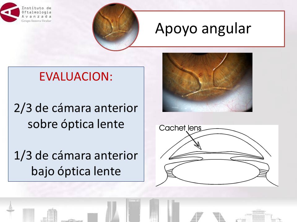 Apoyo angular EVALUACION: 2/3 de cámara anterior sobre óptica lente