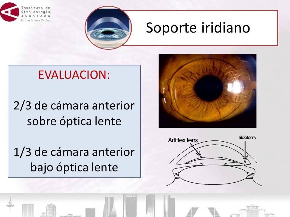 Soporte iridiano EVALUACION: 2/3 de cámara anterior sobre óptica lente
