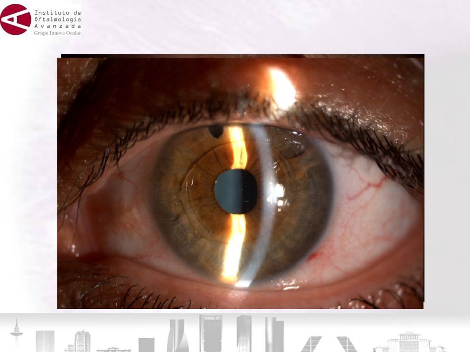 Colocar una lente intraocular es una operación de mayor envergadura