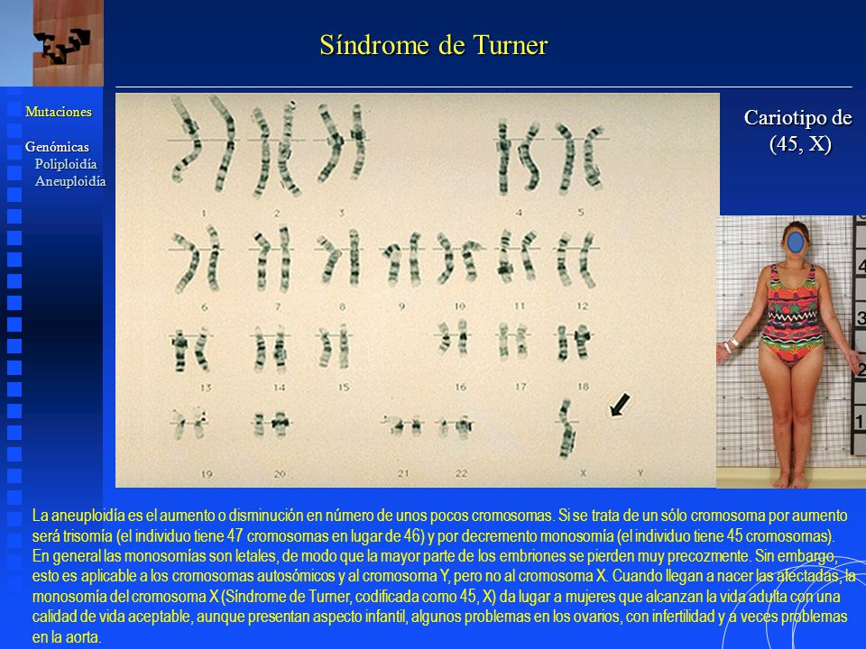 Síndrome de Turner Cariotipo de (45, X)