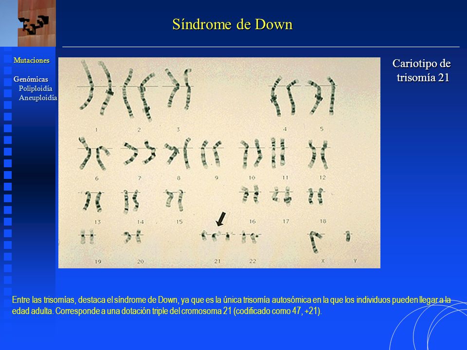 Síndrome de Down Cariotipo de trisomía 21