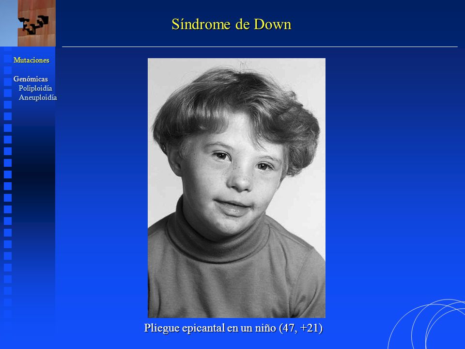 Síndrome de Down Pliegue epicantal en un niño (47, +21) Mutaciones