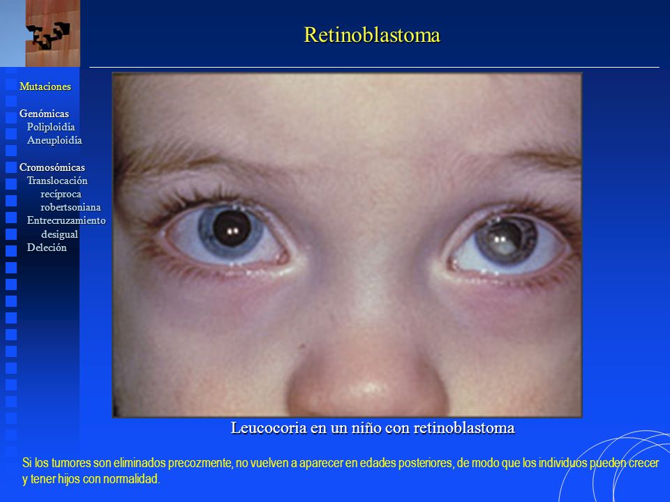 Retinoblastoma Leucocoria en un niño con retinoblastoma