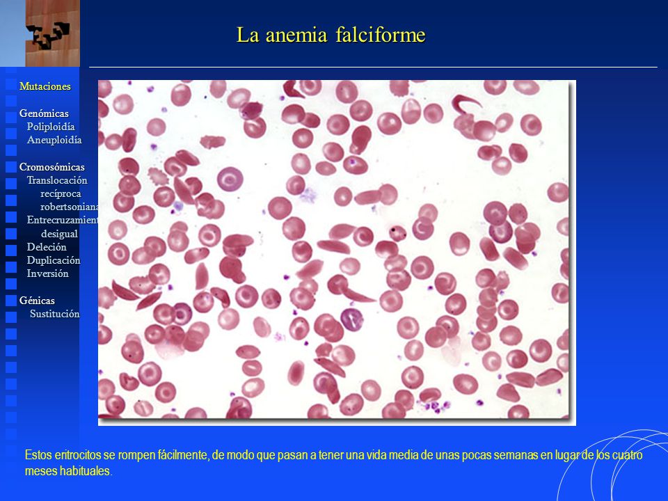 La anemia falciforme Mutaciones. Genómicas. Poliploidía. Aneuploidía. Cromosómicas. Translocación.