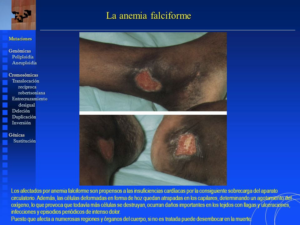 La anemia falciforme Mutaciones. Genómicas. Poliploidía. Aneuploidía. Cromosómicas. Translocación.