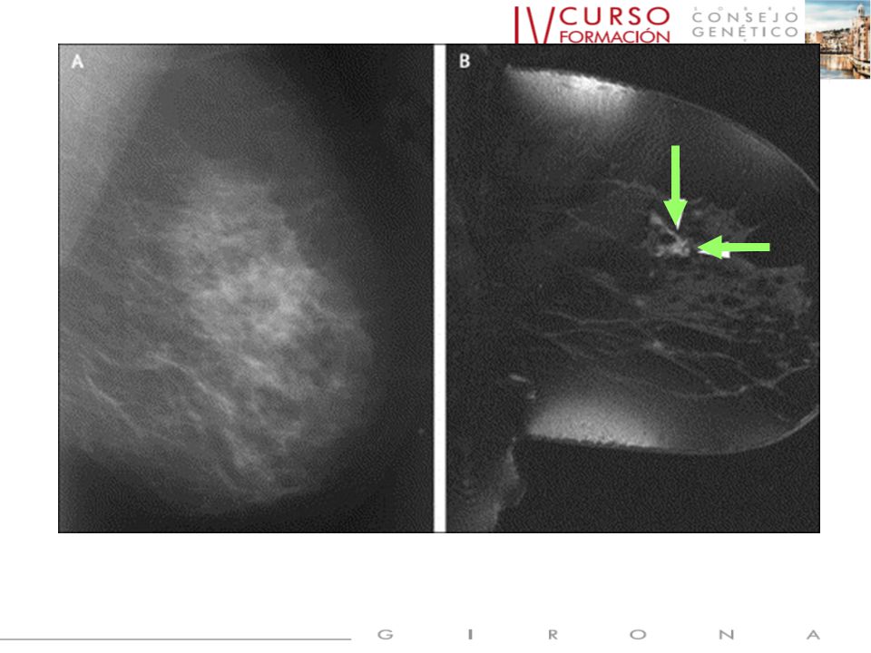 59 a. BRCA1+. Screening with magnetic resonance imaging and mammography of a UK population at high familial.