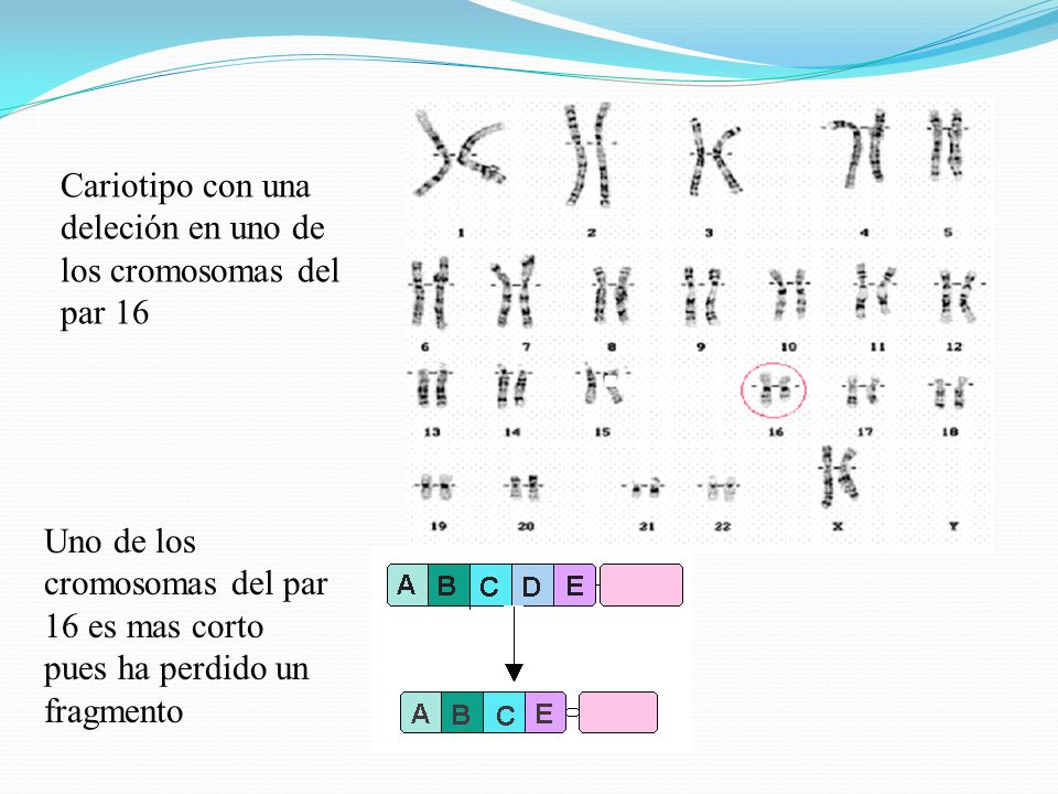 Cariotipo con una deleción en uno de los cromosomas del par 16