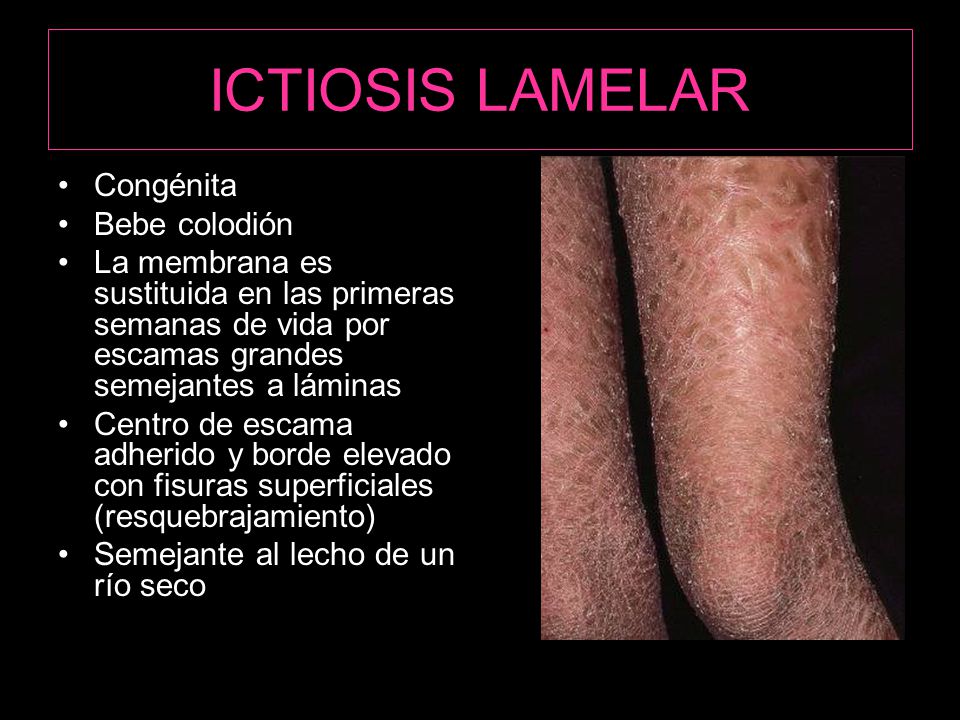 ICTIOSIS LAMELAR Congénita Bebe colodión