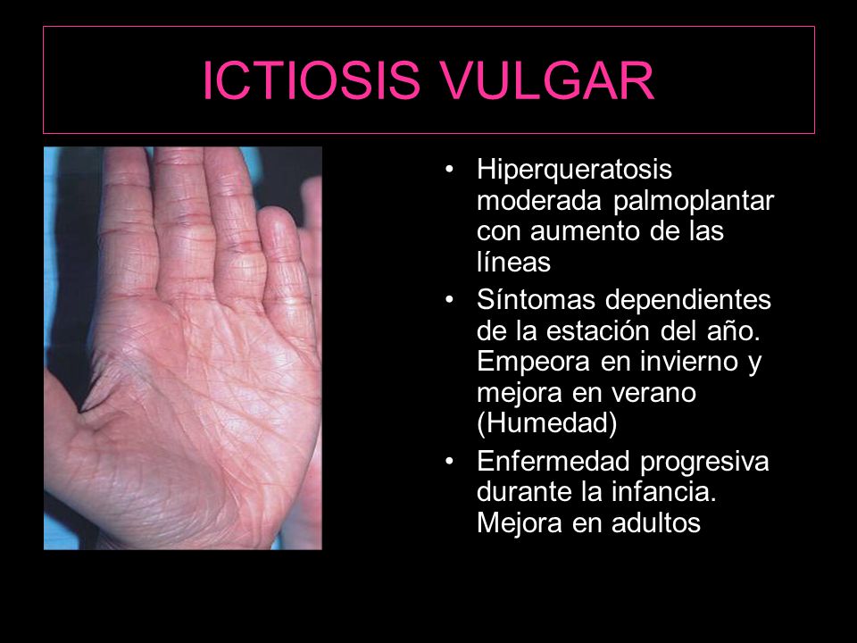 ICTIOSIS VULGAR Hiperqueratosis moderada palmoplantar con aumento de las líneas.