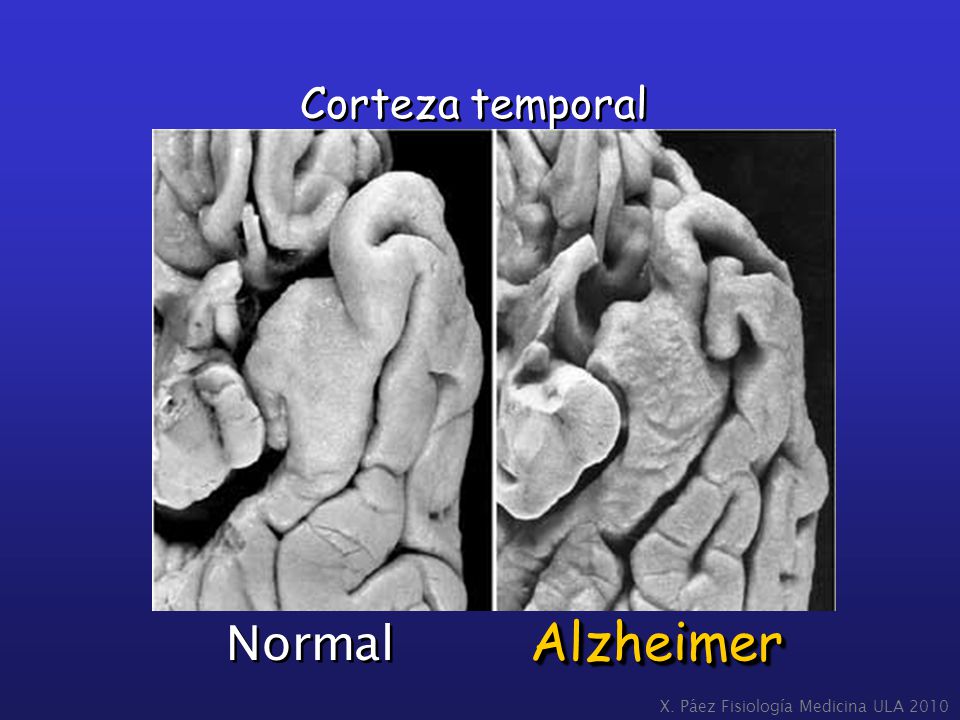 Corteza temporal Normal Alzheimer X. Páez Fisiología Medicina ULA 2010