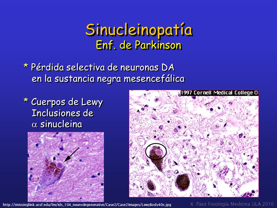 Sinucleinopatía Enf. de Parkinson * Pérdida selectiva de neuronas DA