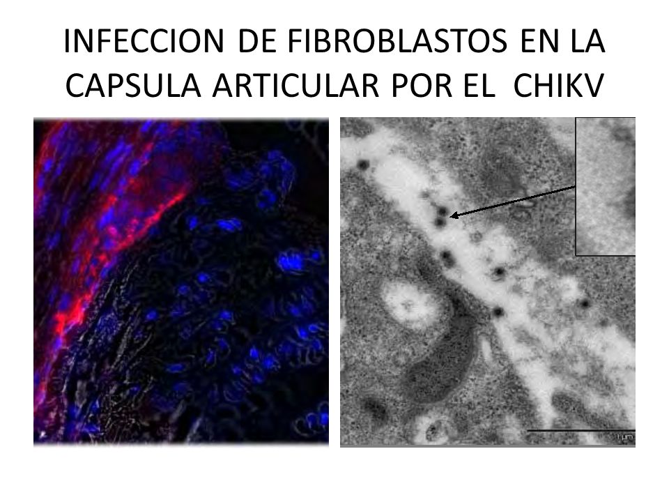 INFECCION DE FIBROBLASTOS EN LA CAPSULA ARTICULAR POR EL CHIKV