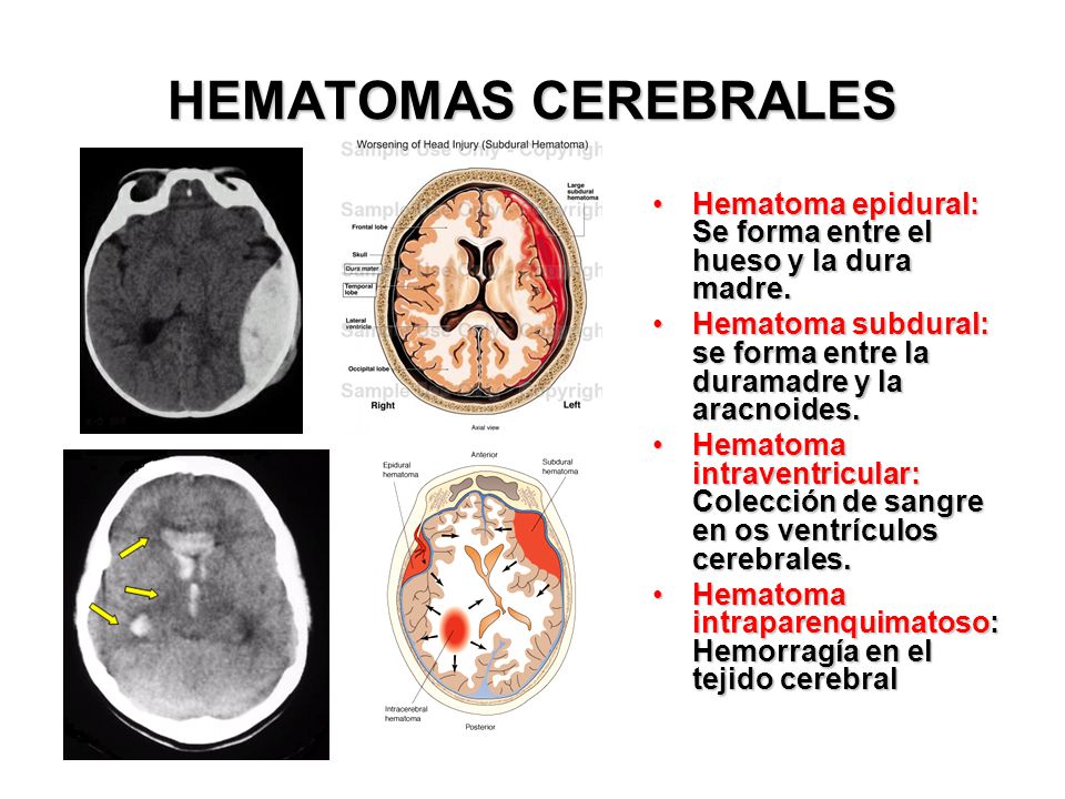 HEMATOMAS CEREBRALES Hematoma epidural: Se forma entre el hueso y la dura madre. Hematoma subdural: se forma entre la duramadre y la aracnoides.