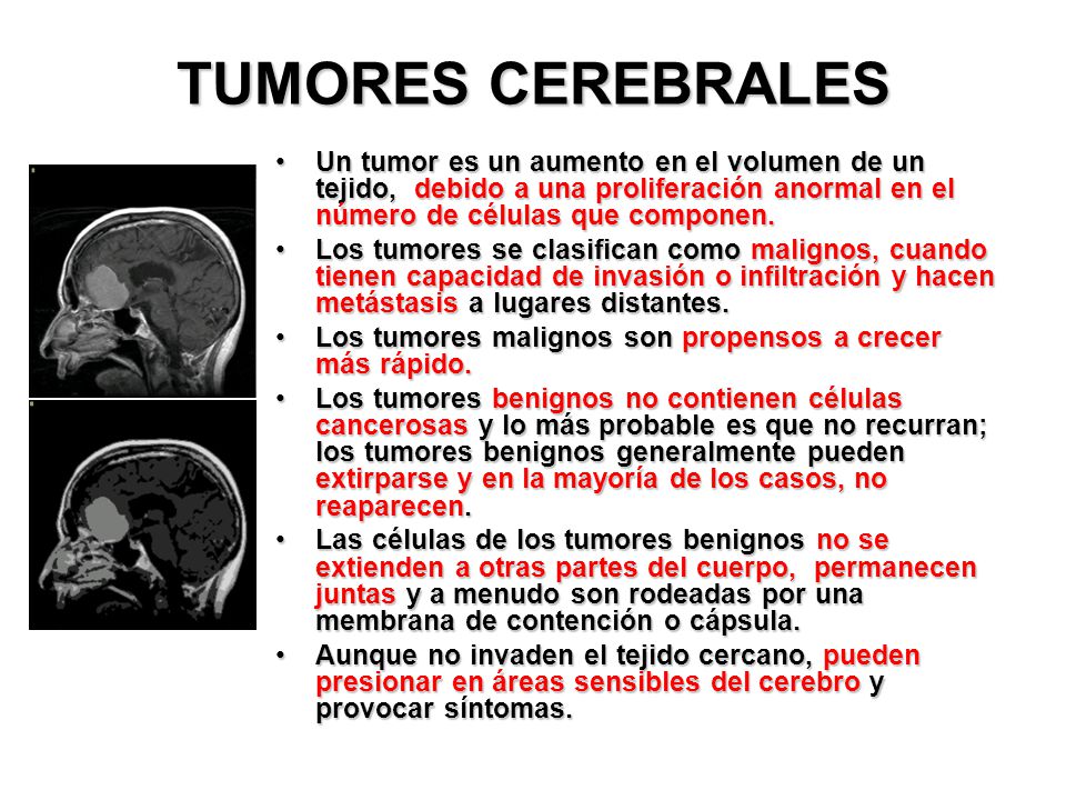 TUMORES CEREBRALES Un tumor es un aumento en el volumen de un tejido, debido a una proliferación anormal en el número de células que componen.