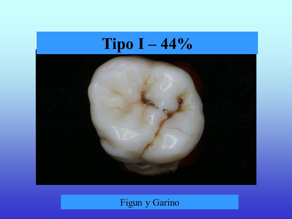 Tipo I – 44% Figun y Garino