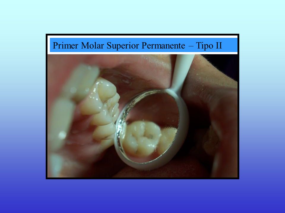 Primer Molar Superior Permanente – Tipo II