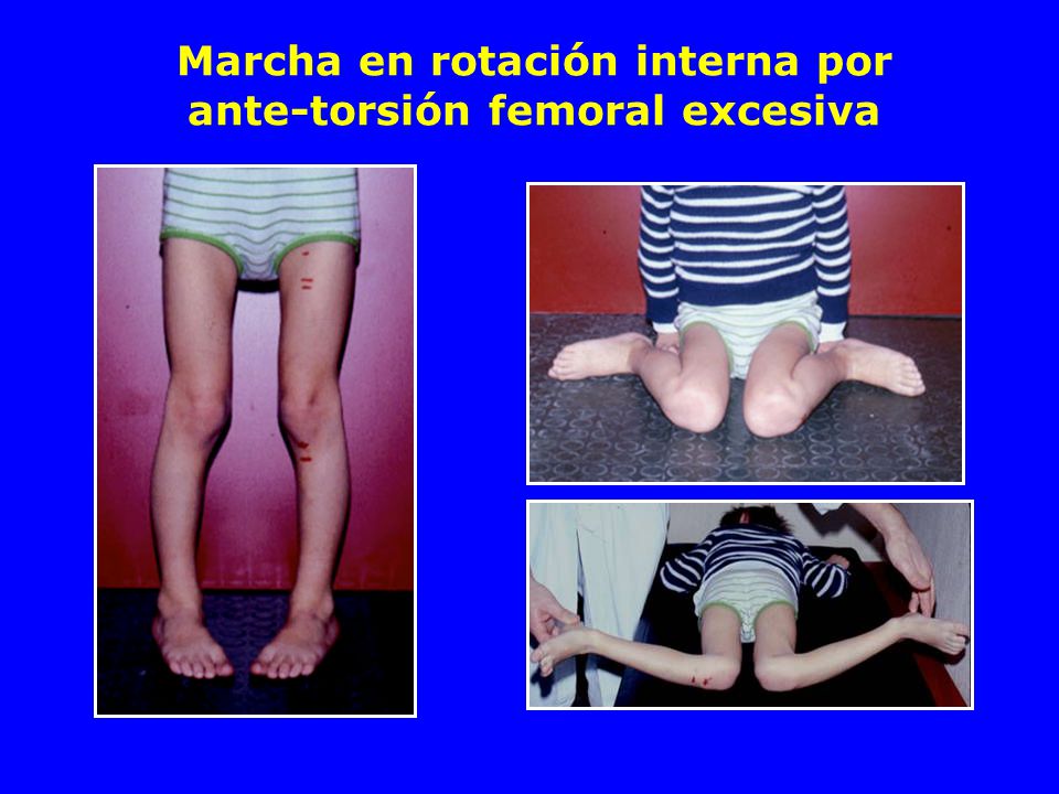 Marcha en rotación interna por ante-torsión femoral excesiva