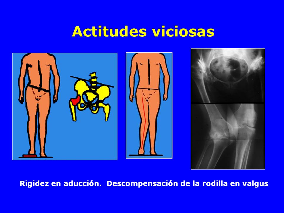 Actitudes viciosas Rigidez en aducción. Descompensación de la rodilla en valgus