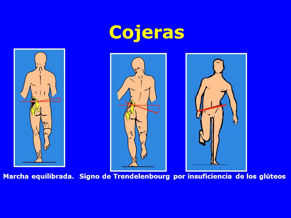Cojeras Marcha equilibrada. Signo de Trendelenbourg por insuficiencia de los glúteos