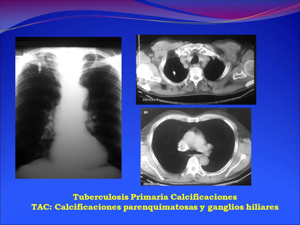 Tuberculosis Primaria Calcificaciones TAC: Calcificaciones parenquimatosas y ganglios hiliares