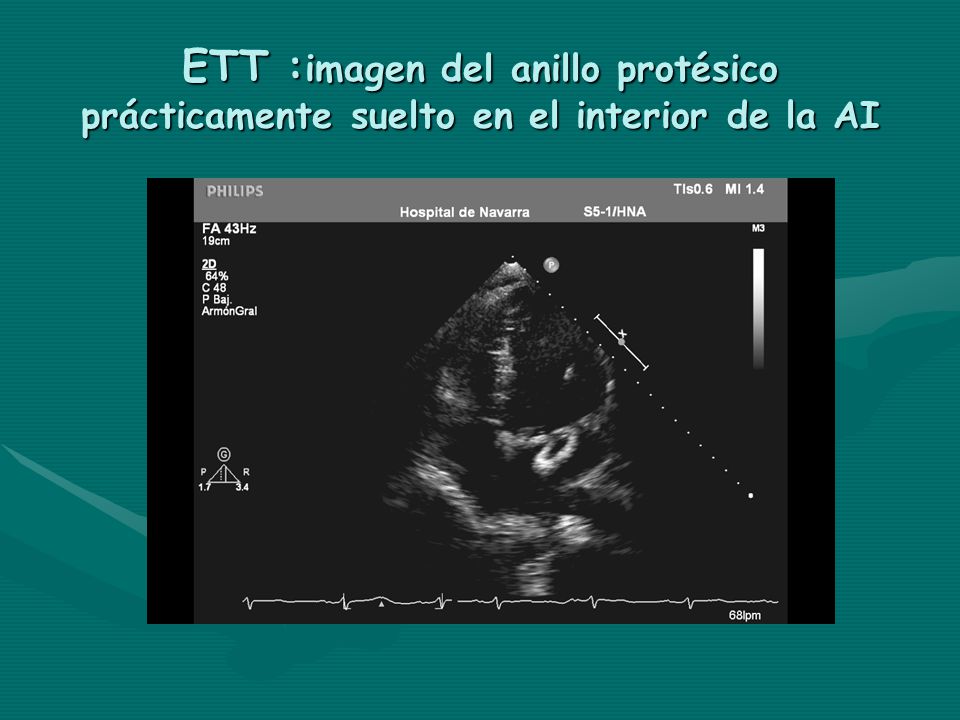 ETT :imagen del anillo protésico prácticamente suelto en el interior de la AI