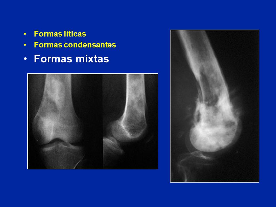 Formas líticas Formas condensantes Formas mixtas