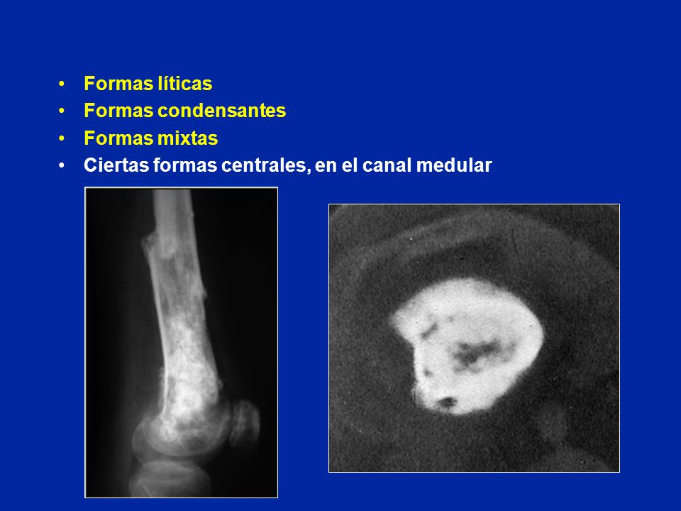 Formas líticas Formas condensantes Formas mixtas Ciertas formas centrales, en el canal medular