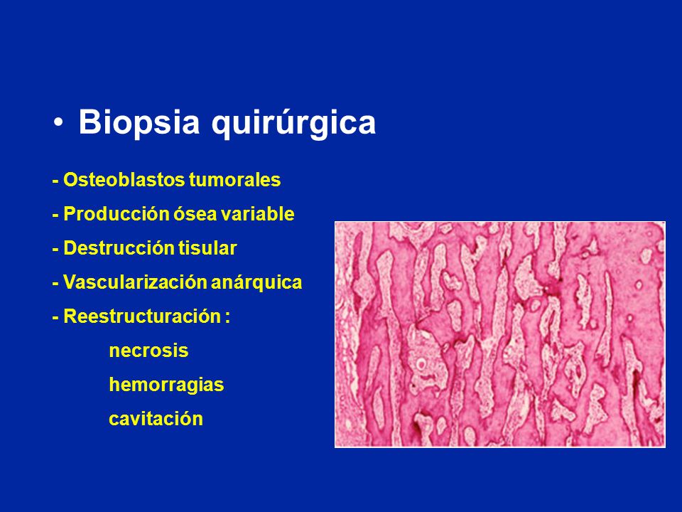 Biopsia quirúrgica - Osteoblastos tumorales - Producción ósea variable